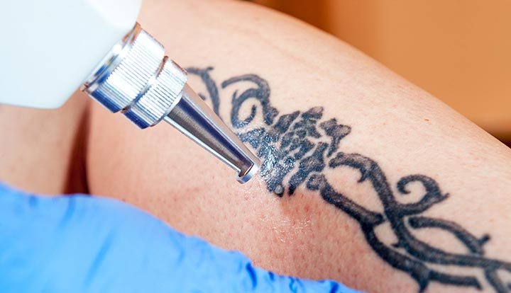 Tatto Removal