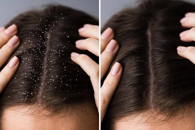 Dandruff Treatment