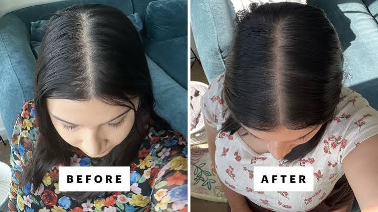 Hair PRP