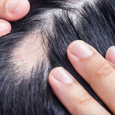 Alopecia Treatment