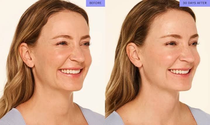 Botox