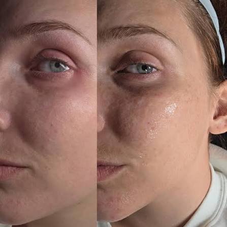 Glow & Go Peel (Lunch-Time Peel)