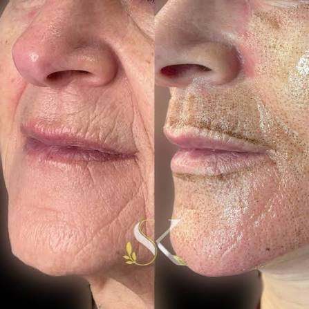 PlasmaLift Microneedling